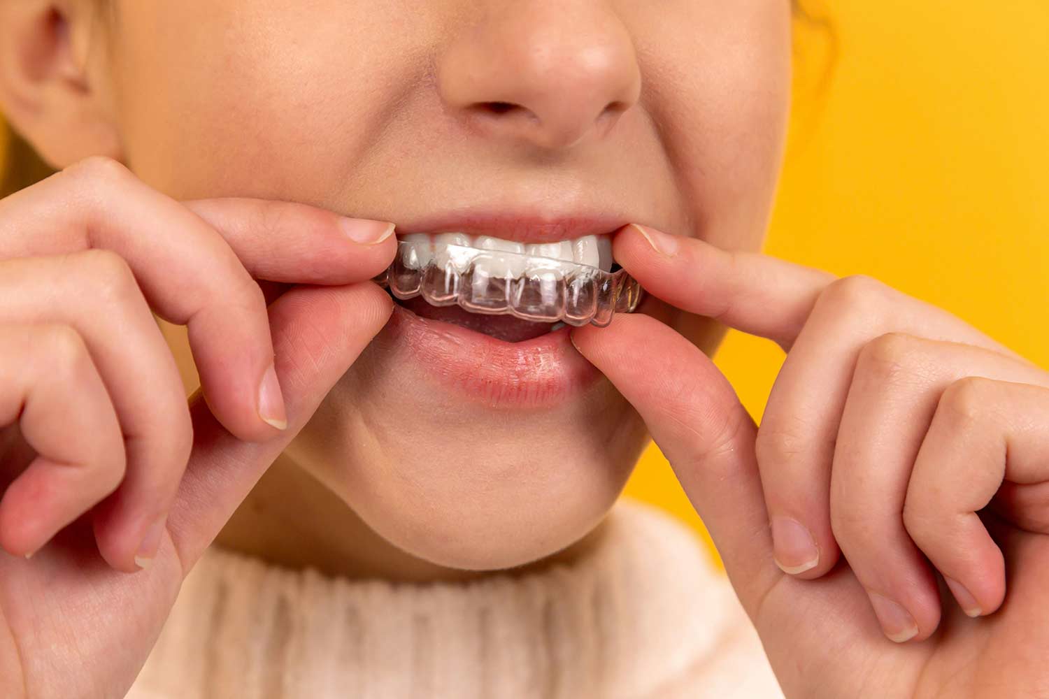 Photo of a person placing clear aligner therapy in their mouth