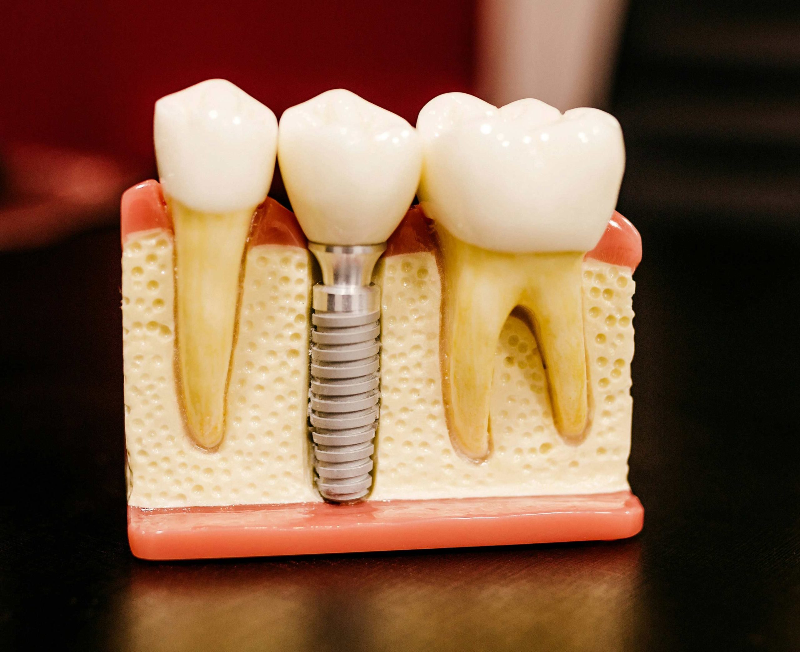 jonathan-borba-W9YEY6G8LVM-unsplash Photo of a Dental Implant