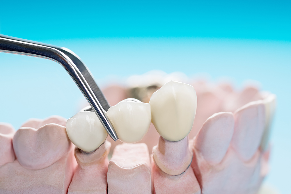 dental-crown-bridge-image An example of a dental crown