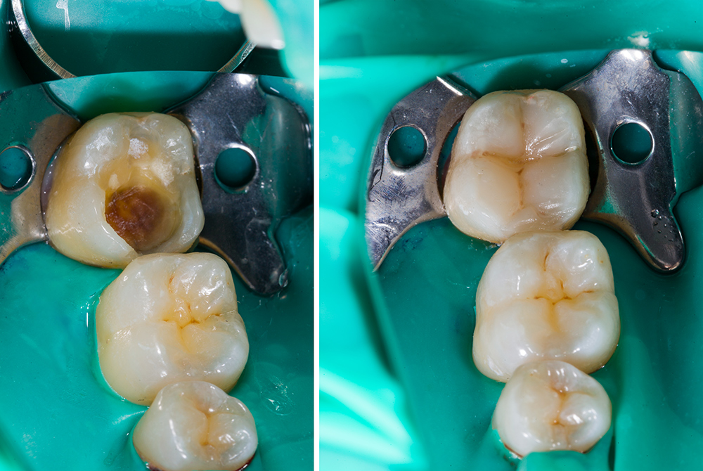 dental-filings-image Example of a dental filling