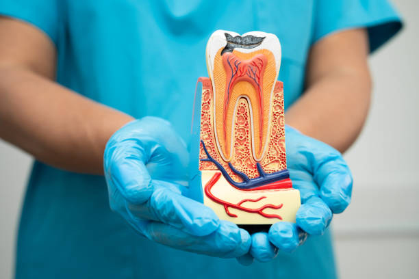 root-canal-photo Model of a tooth in need of a root canal