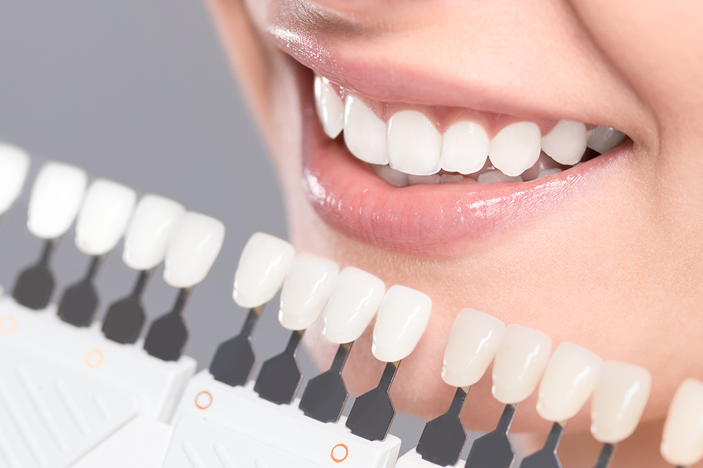 teeth-whitening-image Teeth whitening