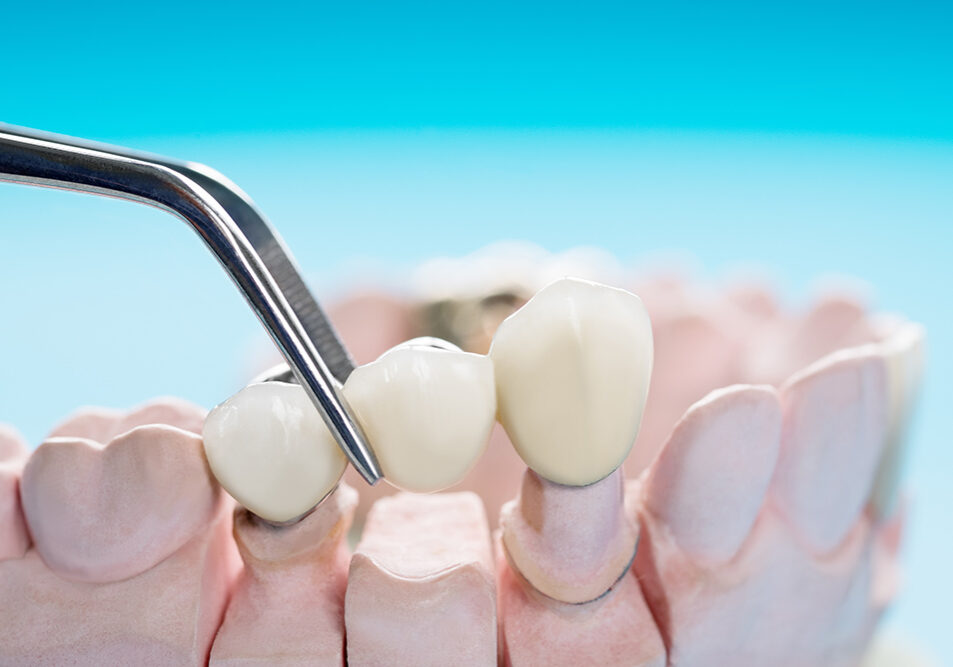 An example of a dental crown