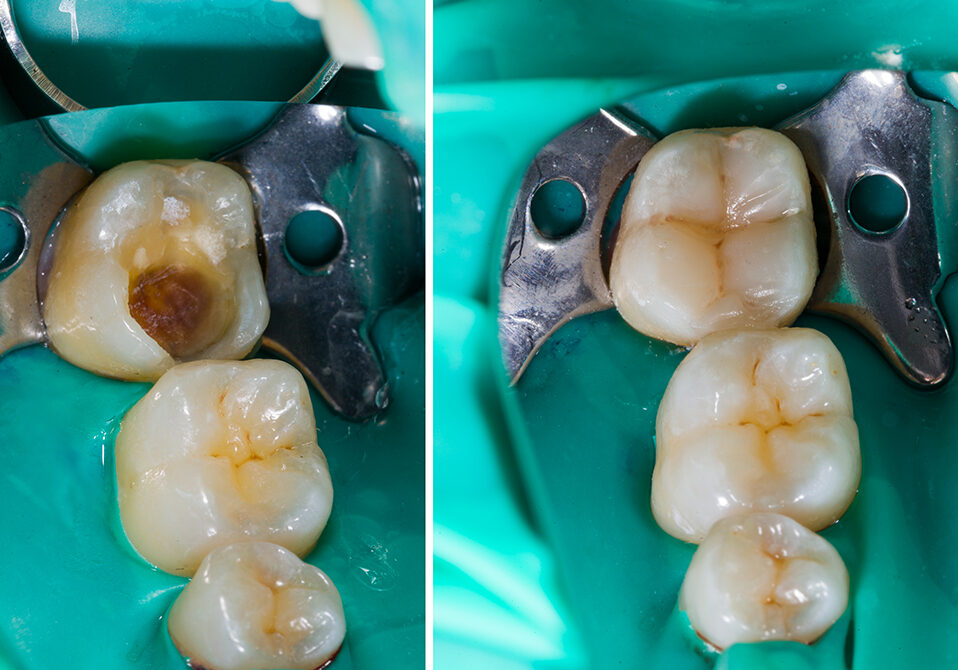 Example of a dental filling