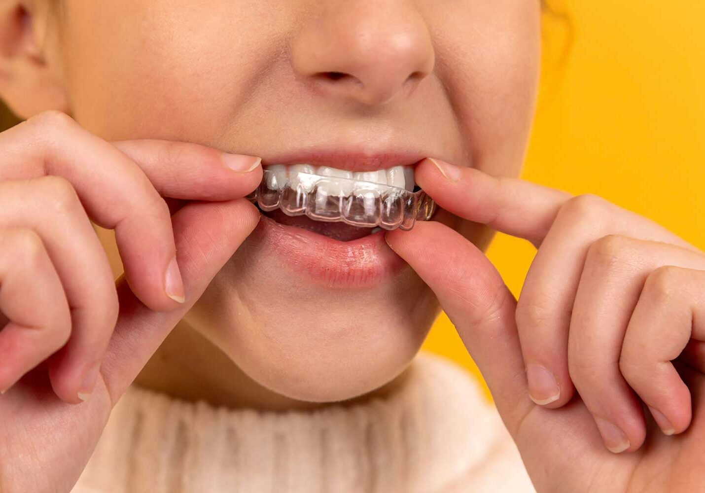 Photo of a person placing clear aligner therapy in their mouth