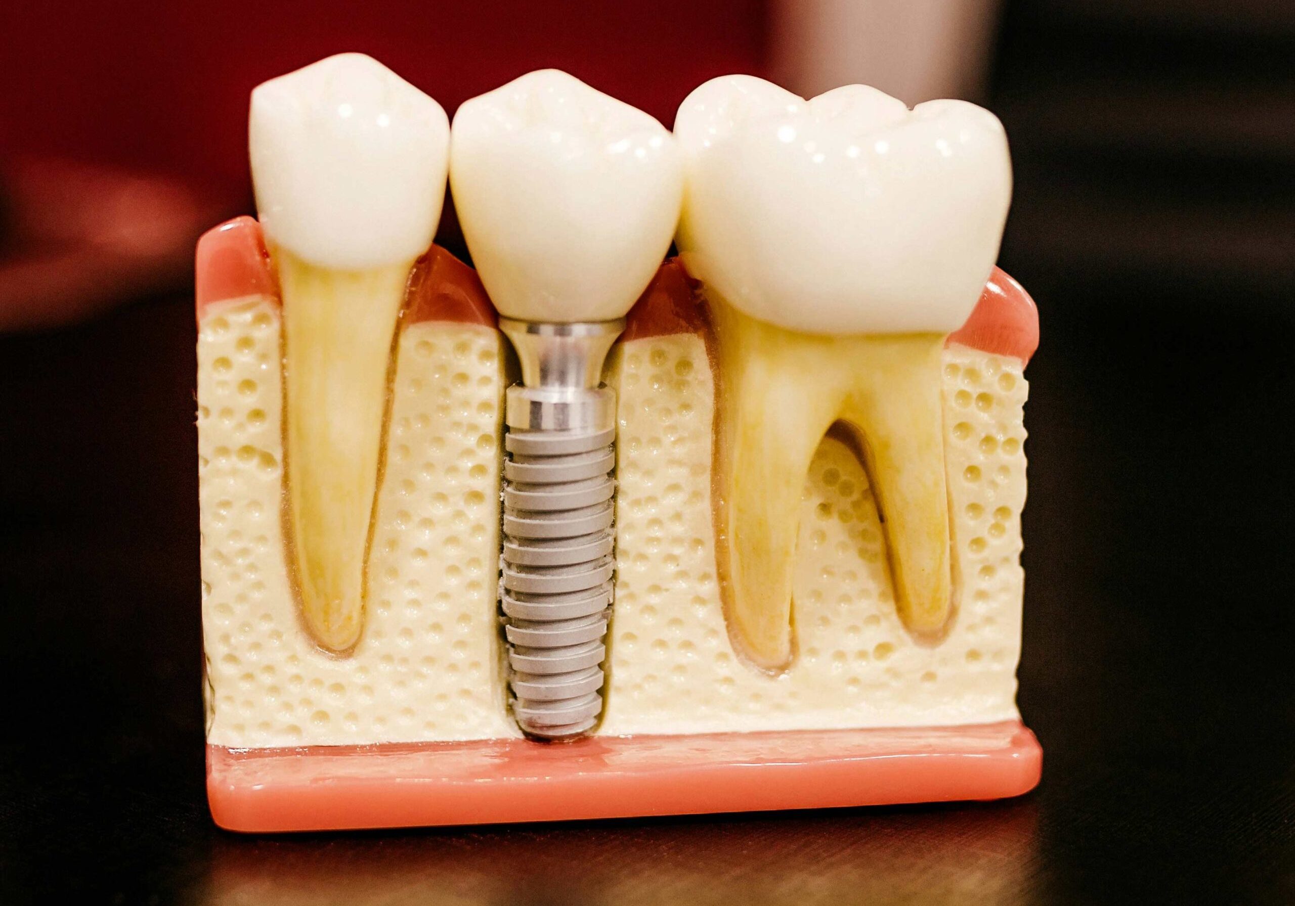 Photo of a Dental Implant