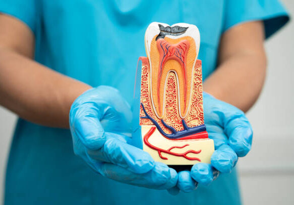 Model of a tooth in need of a root canal